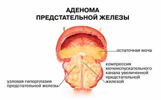 Действие мочегонных трав: правила применения и показания