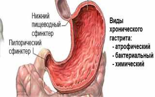 Причины возникновения хронического гастрита