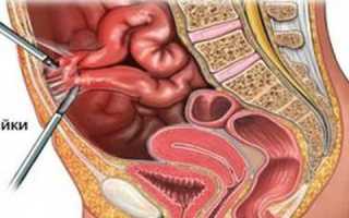 Лечение и профилактика спаечной болезни брюшной полости