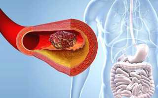 Чем опасен тромбоз кишечника и как его лечить?