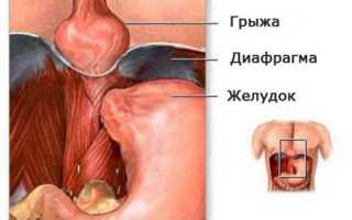 Развитие и лечение грыжи пищевода