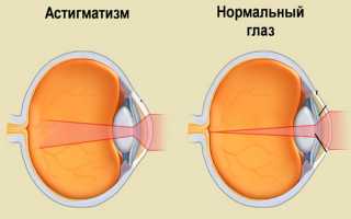 Можно ли носить обычные линзы при астигматизме