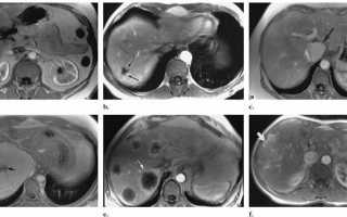 Что показывает МРТ печени?