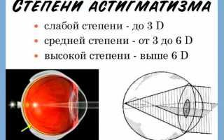 Как проявляется сложный миопический астигматизм — в чем его опасность