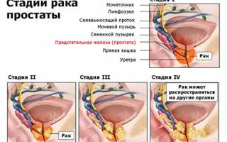 Рак простаты. Удаление простаты: последствия