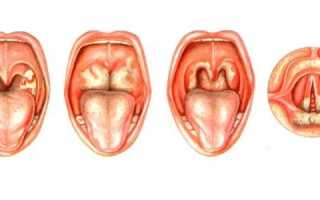Белый налет на миндалинах с температурой и без — причины и лечение