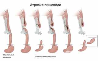 Что такое атрезия пищевода?