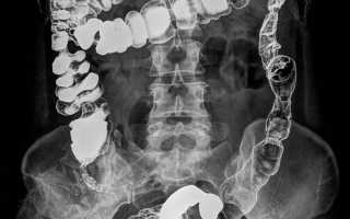 Проведение процедуры рентгена кишечника с барием