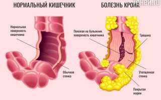 Симптомы, диагностика и лечение болезни Крона