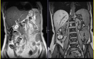Какая подготовка нужна к МРТ брюшной полости?