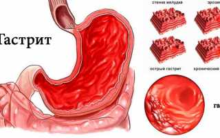 Методика лечения гипертрофического гастрита