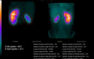 Как проводят сцинтиграфию почек: особенности исследования и расшифровка результатов