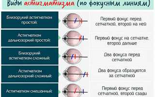 Как распознать сложный гиперметропический астигматизм в домашних условиях