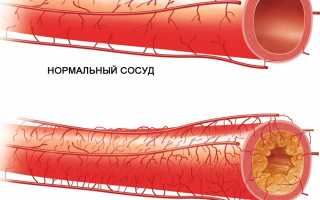 Гиперурикемия — что это такое и как с нею бороться