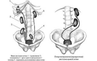Виды дистопии почки: характер симптомов и лечение