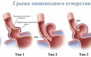 Можно ли вылечить грыжу пищевода без операции?