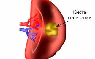 Как лечится киста селезенки?