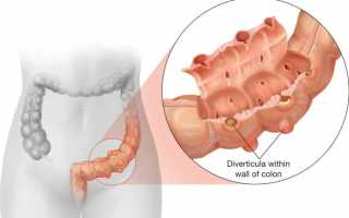 Симптоматика и лечение дивертикулита сигмовидной кишки