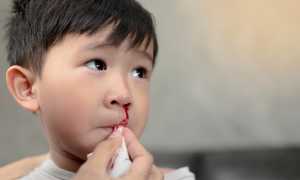 Причины крови из носа ночью у ребенка: советы Комаровского