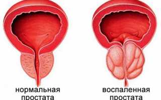 Если у мужа простатит, можно ли забеременеть: влияние простатита на потенцию и качество спермы