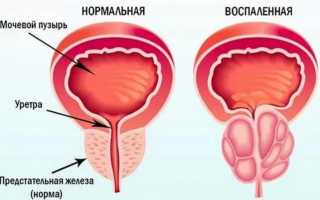 Приступ простатита: что делать, оказание первой помощи, способы устранения причины и применение народных средств