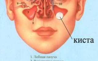 Киста в пазухе носа — симптомы, как проводят операцию, возможные последствия