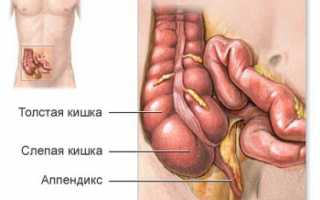 Лечение и народные средства при воспалении слепой кишки