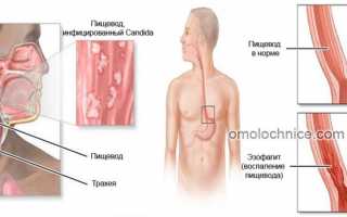 Лечение кандидоза пищевода