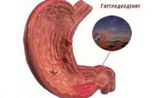 Лечение и диета при эрозивном гастродуодените