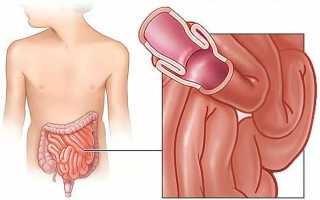 Что такое инвагинация кишечника?