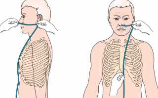 Что необходимо знать про использование назогастрального зонда?