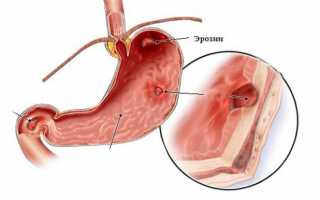Общее представление об эрозивном гастрите