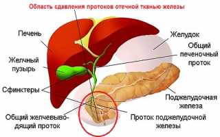 Профилактика и лечение псевдотуморозного панкреатита