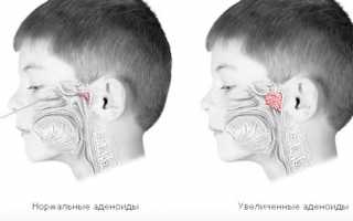 Сопли при аденоидах — как лечить у детей и взрослых