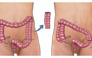 Почему происходит опущение кишечника?