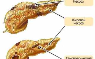 Виды и лечение геморрагического панкреонекроза