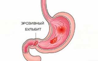 Воспаление луковицы двенадцатиперстной кишки — эрозивный бульбит