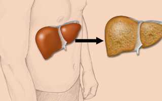 Симптомы и лечение стеатоза печени