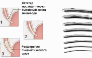 Зачем делают бужирование пищевода?