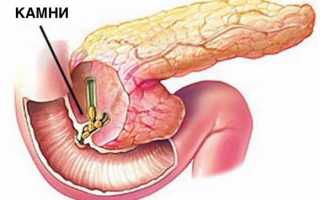 Как избавиться от камней в поджелудочной железе?