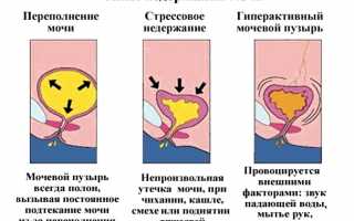 Недержание мочи во время чихания и кашля: причины проблемы и способы устранения