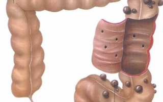 Лечение и осложнения при дивертикулезе сигмовидной кишки