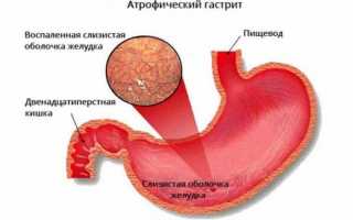 Диагностика и лечение очагового атрофического гастрита