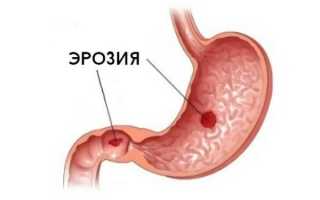 Причины и лечение эрозивного антрального гастрита
