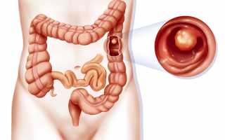 Полип толстой кишки — очаговое разрастание клеток