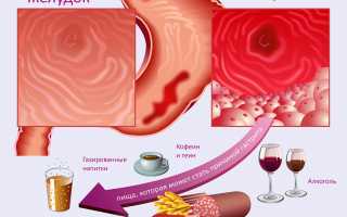 Признаки и способы лечения эритематозного гастрита
