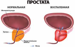 Причины возникновения и симптомы посткоитального цистита