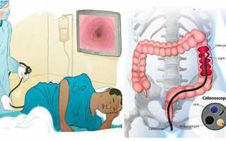 Что такое колоноскопия кишечника и больно ли это?