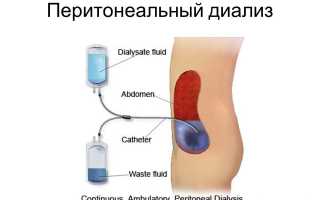 Порядок проведения перитонеального диализа: виды и показания