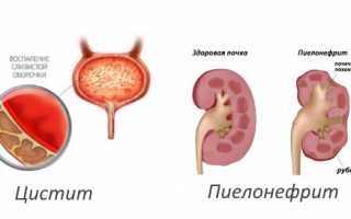 Причины цистита с кровью, симптомы, лечение, последствия и профилактика